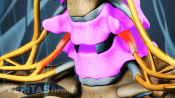 Anterior view of an artificial disc in the cervical spine.