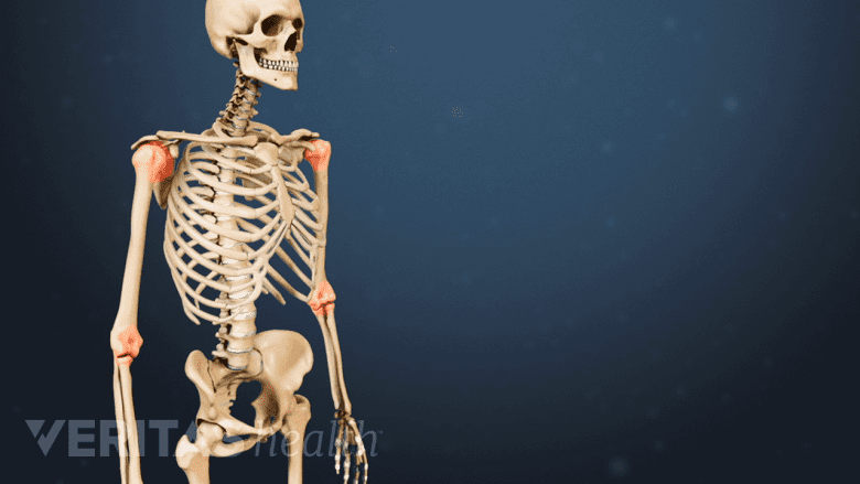 Rheumatoid arthritis of the shoulder and elbow joints.
