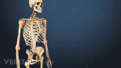 Anterior view of the skeletal system showing rheumatoid arthritis in the arm joints.