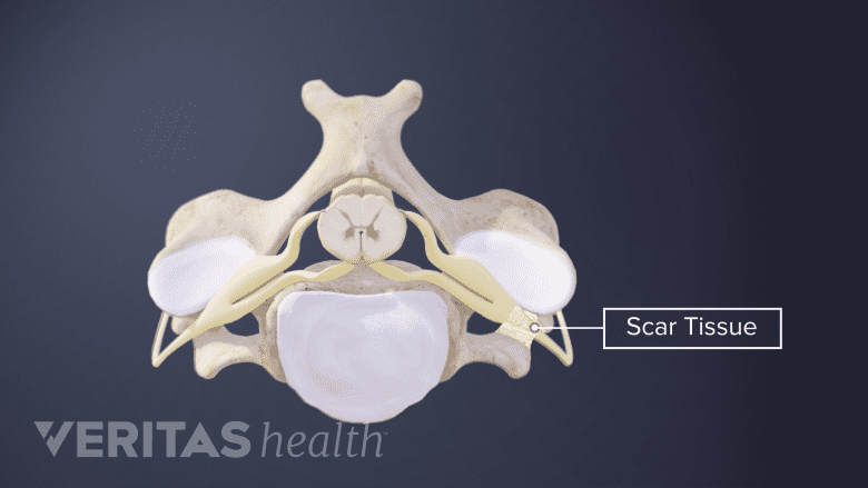 Formation of scar tissue around a spinal nerve root.