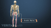 Medical illustration of a skeleton. The sciatic nerve is labeled and highlighted in red indicating pain, numbness or tingling.