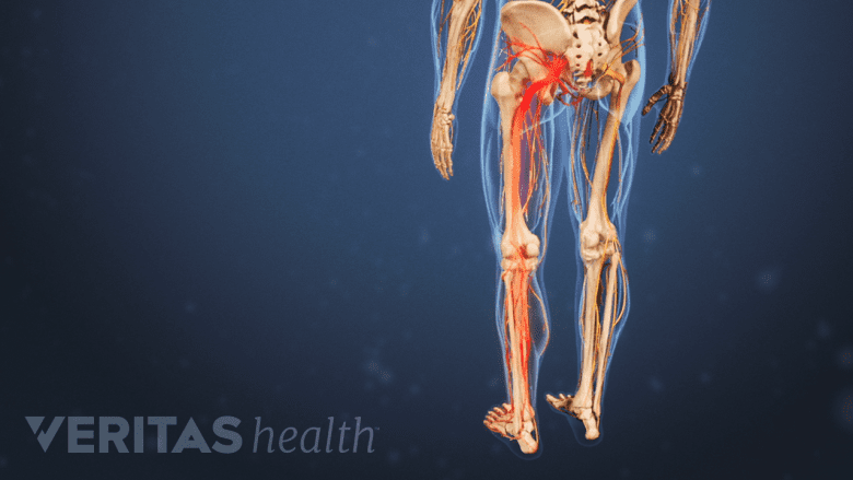 Posterior view of sciatic pain in the left leg.