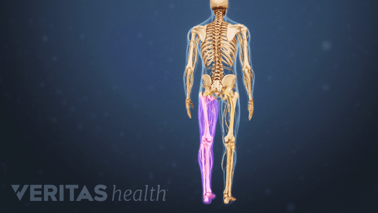 Pain travels down lower back, buttock and leg on one side.