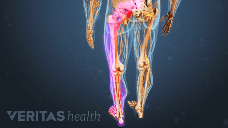 An illustration showing sciatica pain radiating along the path of the nerve.