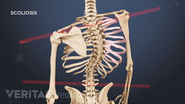 Illustration of a torso showing scoliosis.