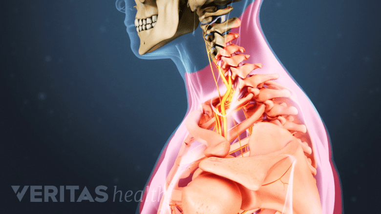 Illustration showing pain areas in the neck and shoulder highlighted in red.