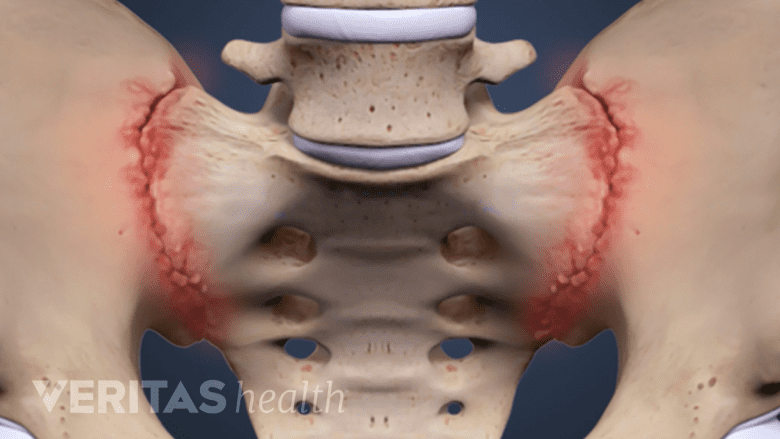 An Illustration showing  adult pelvic bone with sacroiliac joint highlighted in red.