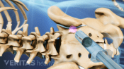 Steroid injection being injected into the sacroiliac joint