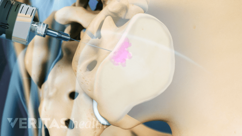 An illustration showing a needle inserted into the SI joint.