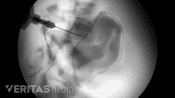 Xray view of an SI Joint Injection