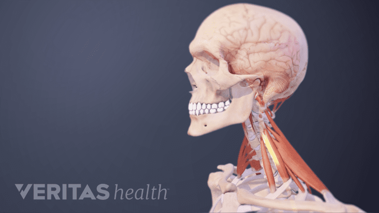Illustration showing neck muscles highlighted in red.