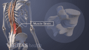 Muscle spasm in the lower back