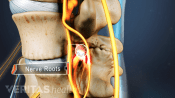 Profile view of the nerve root between two vertebrae