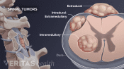 Spinal tumors labeling extradural, intradural, and extramedullary tumors.