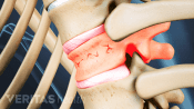 Profile view of a vertebra with spinal compression fracture.