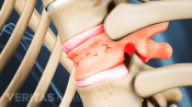 Profile view of a vertebra with spinal compression fracture.