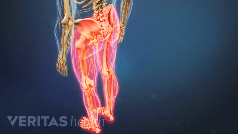 An illustration of an adult with both legs highlighted indicating weakness.