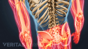 Posterior view of pain in the legs and arms caused by Degenerative Disc Disease.