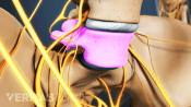 Spondylolysis in the lumbar spine