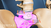Spondylolysis in L5 and S1.