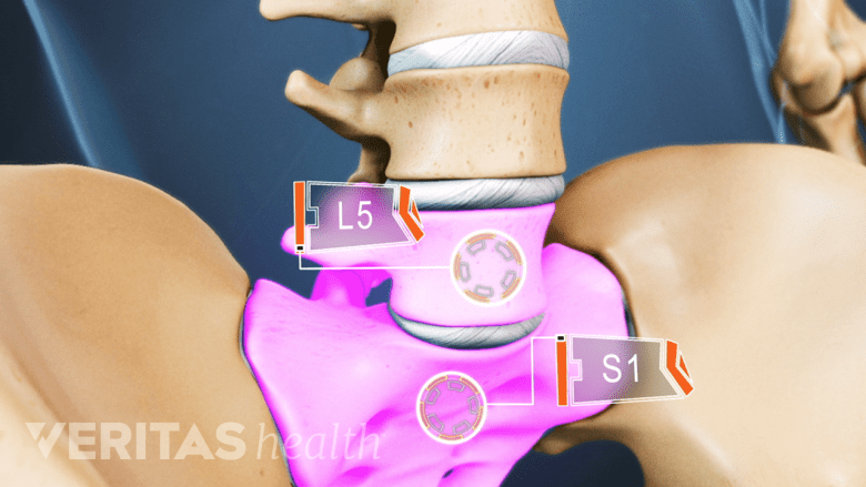 Vista esquelética de la columna lumbar con L5 y S1 resaltados.