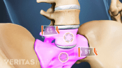 Skeletal view of the lumbar spine with L5 and S1 highlighted