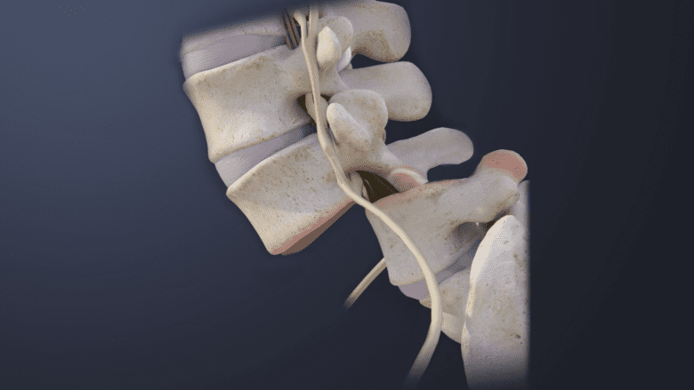 Spondyloptosis