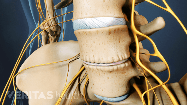 Thinning of the spinal disc due to dehydration.