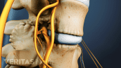 Medical illustration of two vertebrae showing bone spurs on the facet joints