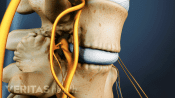 Medical illustration of two vertebrae showing bone spurs on the facet joints