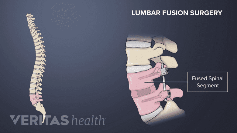 illustration showing vertebral spine and zoomed out fused lumbar vertebra in pink.