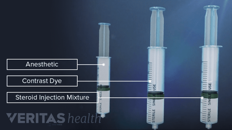 An illustration showing  Epidural steroid injection components.
