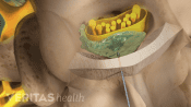 Steroid injection