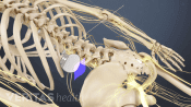 Posterior view of the spinal cord stimulator in the lumbar spine.