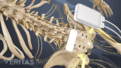 Implantation of spinal cord stimulator for lower back pain