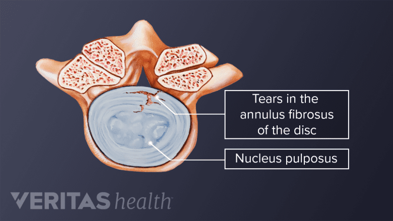 View of tears in the annulus fibrosus of the disc and nucleus pulposus.