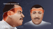 Illustration showing the swath of pain across the forehead caused by a tension headache