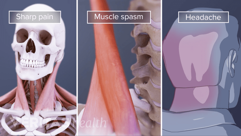 An illustration showing stiff neck muscle pain and haedache.