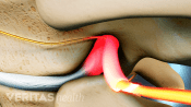 Nerve impingement from a herniated disc in the thoracic spine