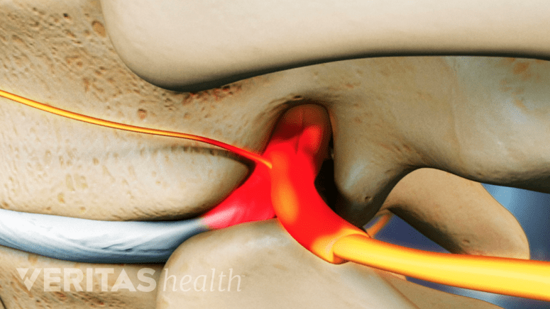Herniated disc pinching a nerve between two vertebrae.