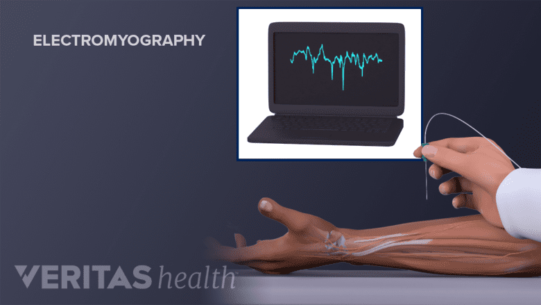 An illustration showing electromyograph.