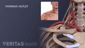Medical illustration of the nerves in the thoracic outlet