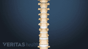 Anterior view of the spine showing a fracture in a thoracic vertebra.