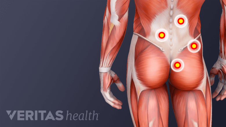 An illustration showing trigger points in the lower back region.