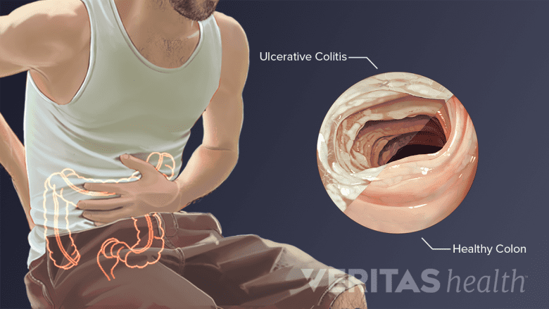 Illustration showing a man grabbing his stomach in pain, and an inset with of a colon showing signs of ulcerative colitis