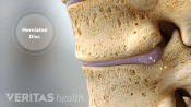 Thoracic herniated disc leaking inflammatory proteins