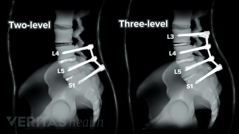 Spine surgery on more than one spinal level (multilevel spinal fusion).