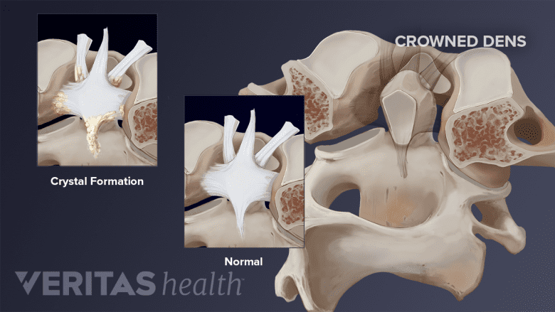 Medical illustration of crowned dens syndrome