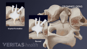 Medical illustration of crowned dens syndrome