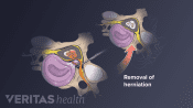 Surgical removal of the herniated part of a spinal disc that&#039;s pressing on the spinal nerves.